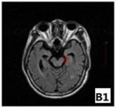 MRI