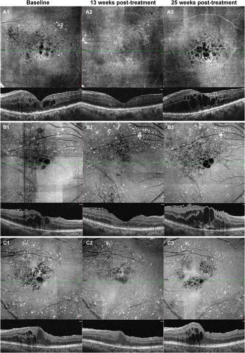 Recurrence of DME was observed in the OCTA en-face and B-scan images of three eyes from the “3 + PRN” group.