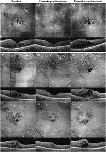 Recurrence of DME was observed in the OCTA en-face and B-scan images of three eyes from the “3 + PRN” group.