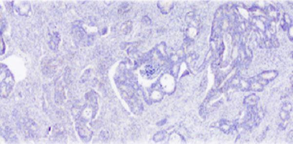 Colon Cancer
