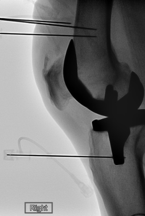 Cooled RFA Relieves Pain after Knee Replacement