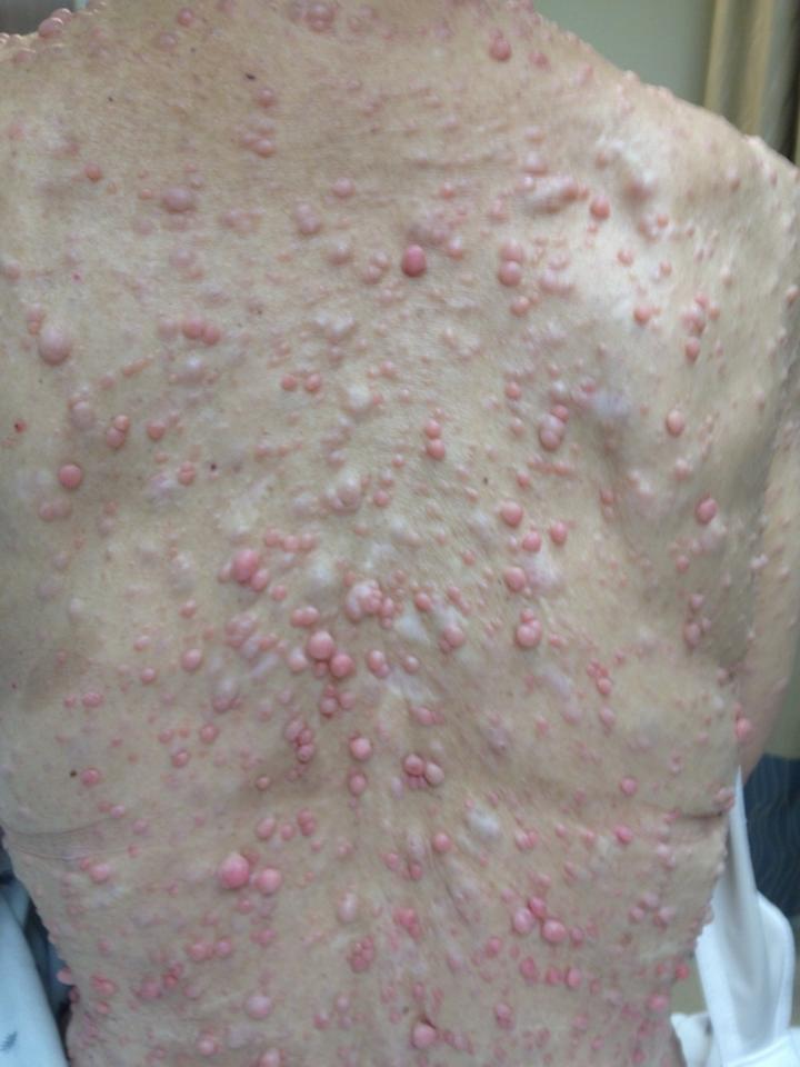 NF1