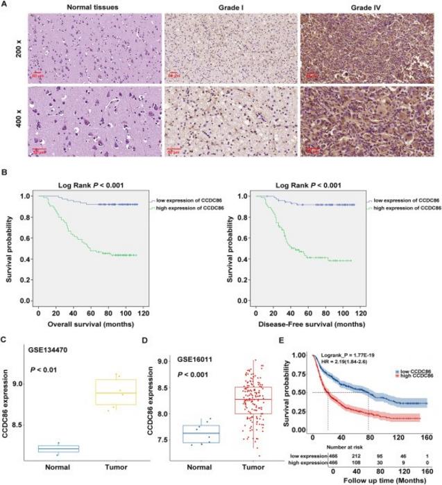 CCDC86 expression as a prognostic marker for glioma.