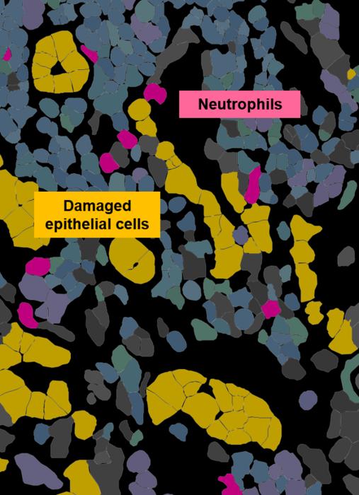 Neutrophil–epithelial niches in the kidney in ANCA-associated vasculitis