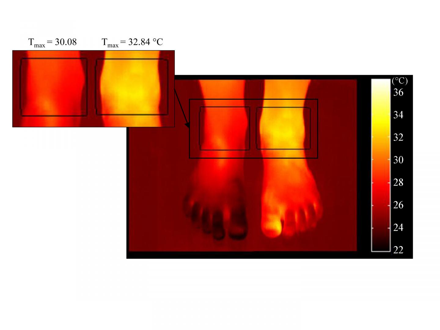 Ankle Joint Temperature Differences