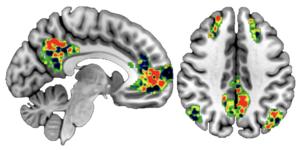 Brain activity preceding self-focused thinking.