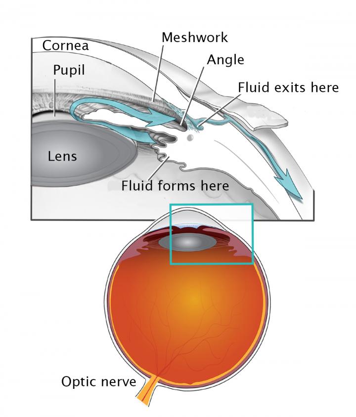 Cataract surgery in infancy increases glaucoma risk