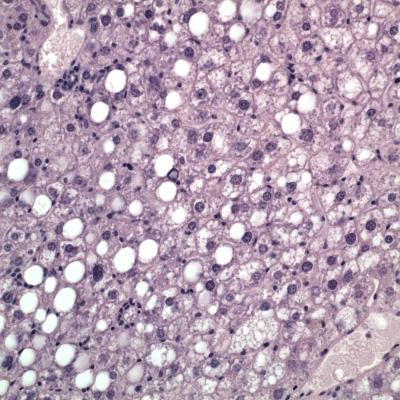 Fatty Liver 