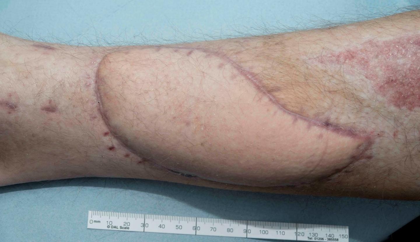 Treated Wound