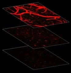 Cerebrospinal Fluid Clears Amyloid Beta From Brain (2 of 3)