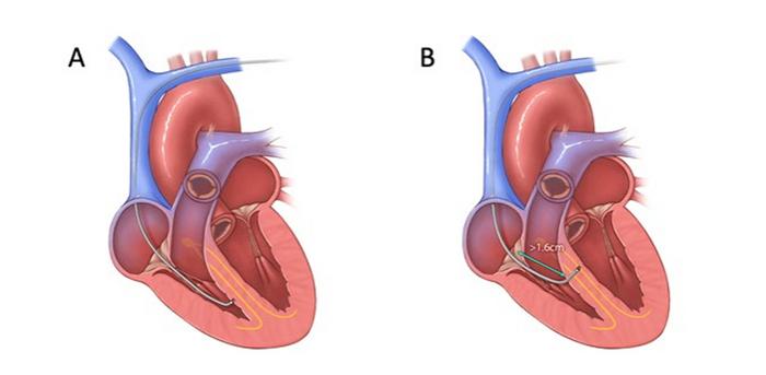 2026 HRS/AHA/APHRS/EHRA/IDSA/LAHRS/PACES/STS Expert Consensus Statement Update on Cardiovascular Implantable Electronic Device Lead Management and Extraction