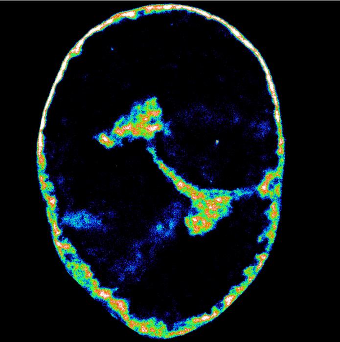 Human DNA eight hours after HSV-1 infection