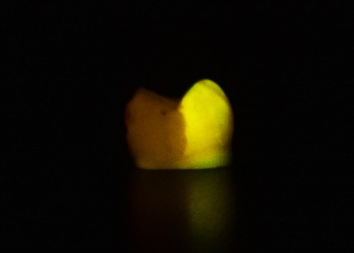 At Long Last, an Effective Remedy for Tooth Enamel Erosion (4 of 5)