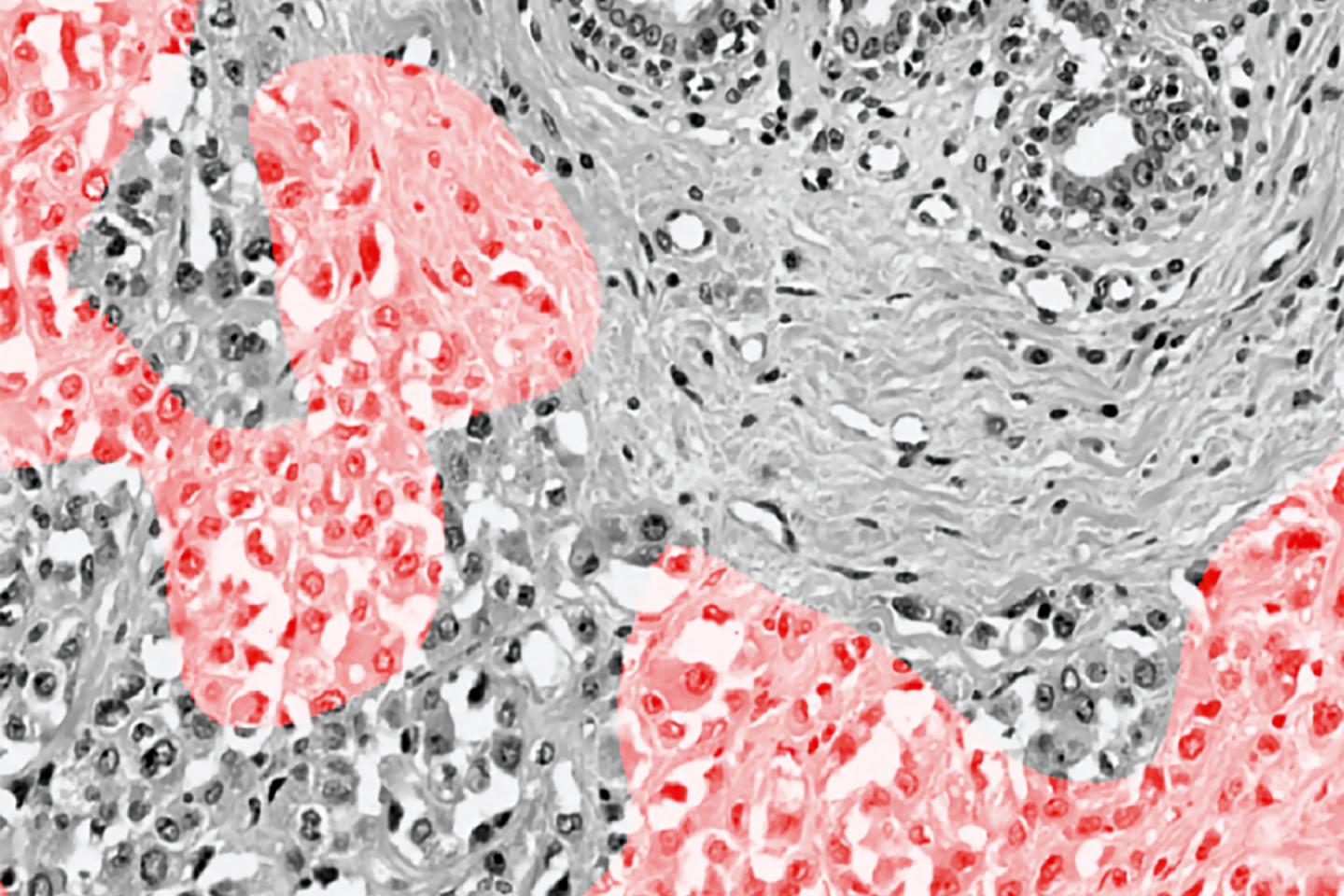 Breast Cancer Cells