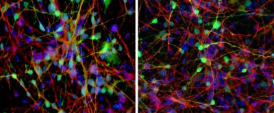 New Method Predicts Who Will Respond to Lithium Therapy