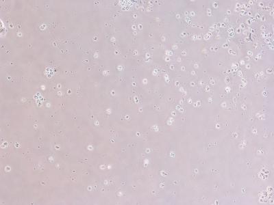 Omega-3 Treated Cancer Keratinocytes