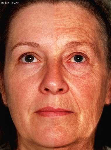 Impact of Aging