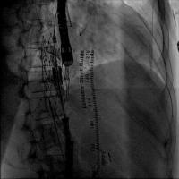 Henry Ford Hospital Replaces Heart Valve Outside the Heart (2 of 3)