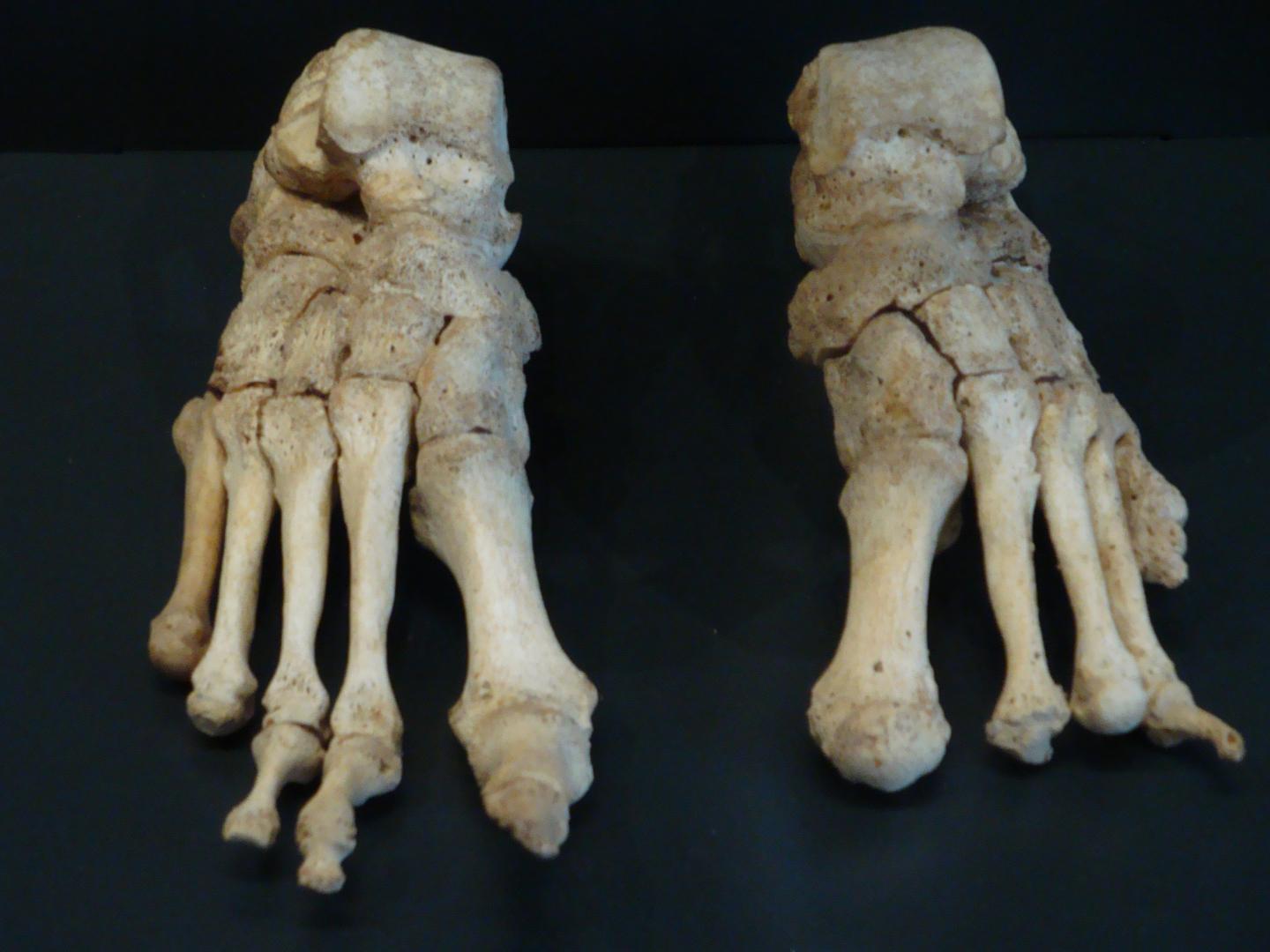 Leprotic Feet