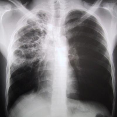 New Drug Lead for Tuberculosis (2 of 2)
