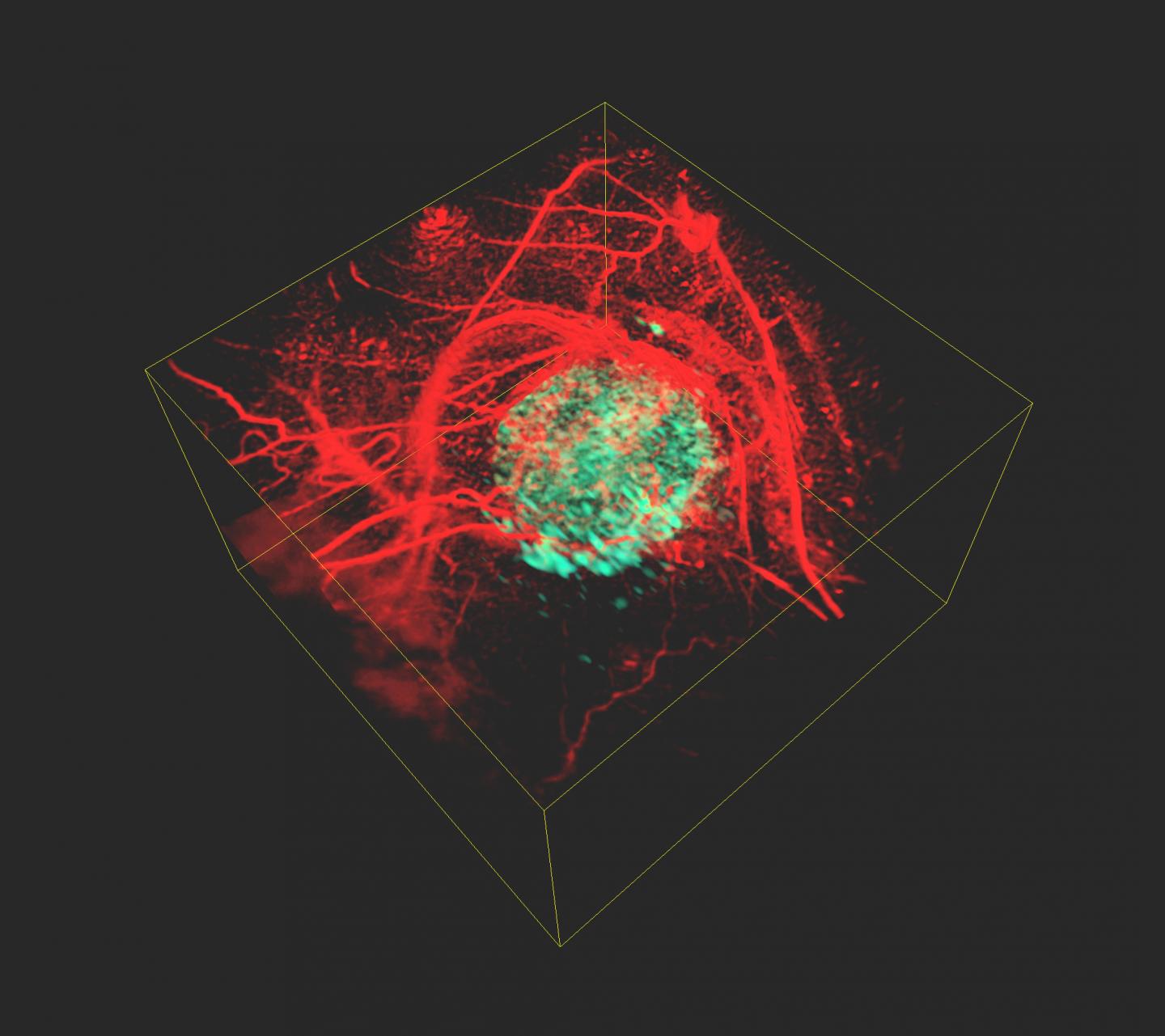 Picture of a Tumor