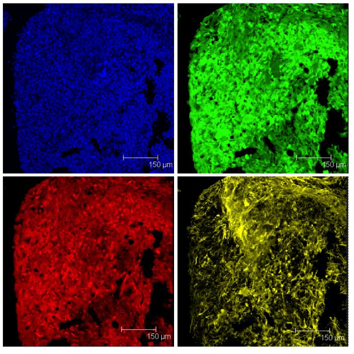 Peptide Drug May Prolong Brain Cancer Survival, Boost Chemotherapy (2 of 3)