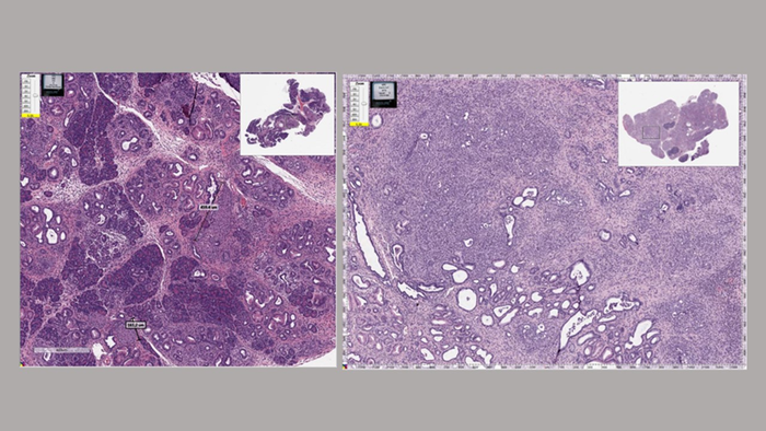 Mouse pancreas with cancer