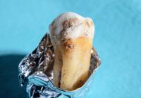 Dental calculus closeup