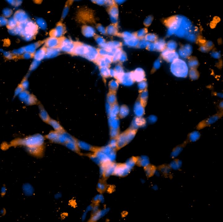 Breast Cancer Cell 