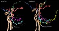 CT Angiography before and after Face Transplantation