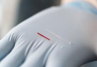 Interstitial fluid for diagnosis -