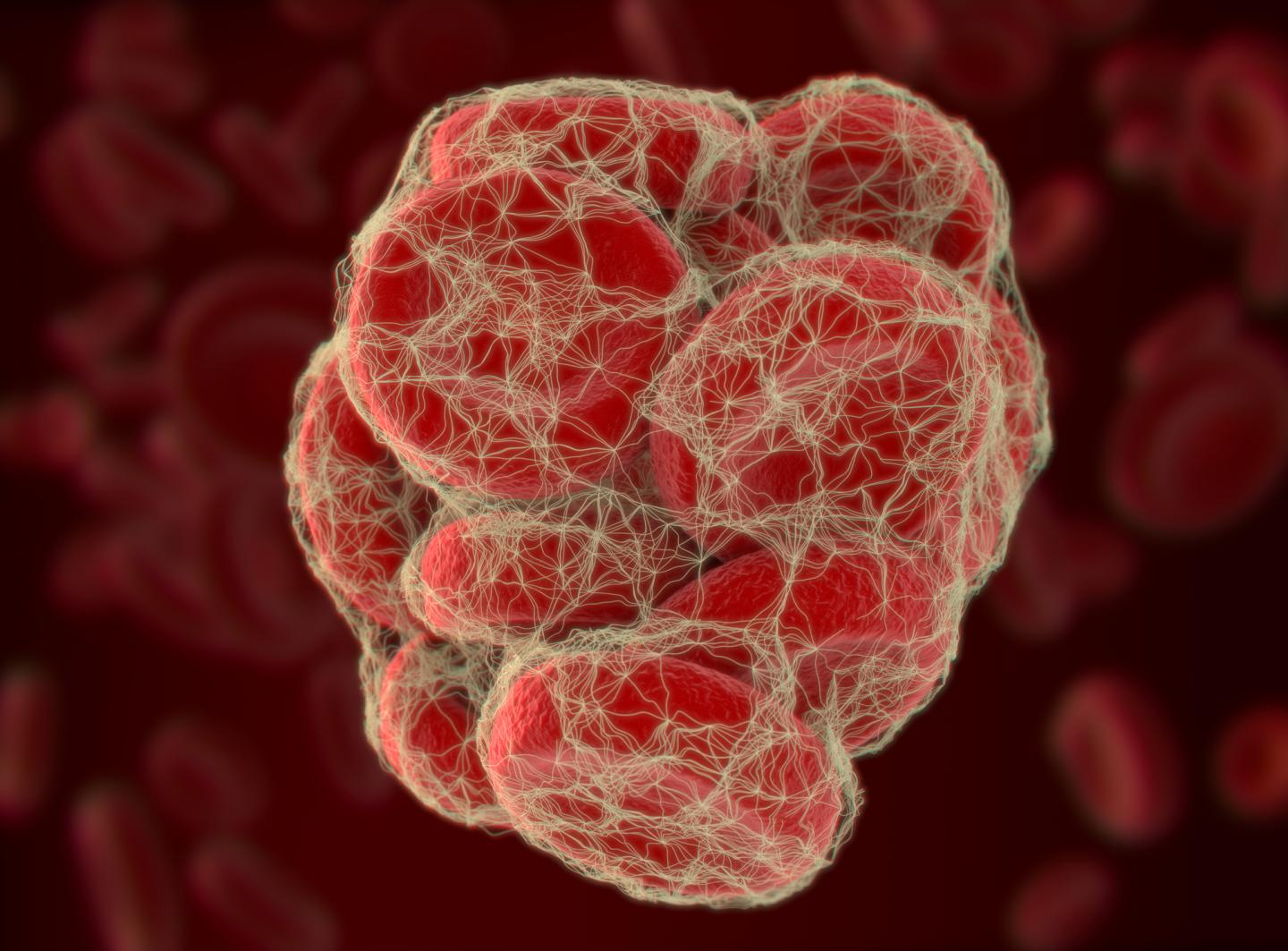 Blood Clot