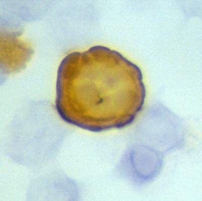 Breast Cancer Cells