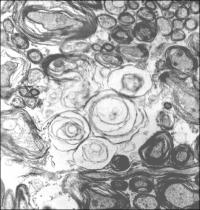 Axons -- Abnormal 