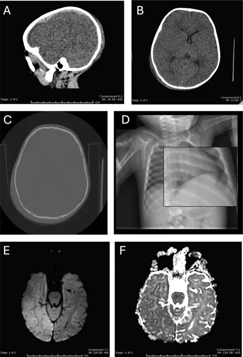 An 8-month-old male with a reported unwitnessed fall and bilateral retinal hemorrhages who presented before the pandemic.
