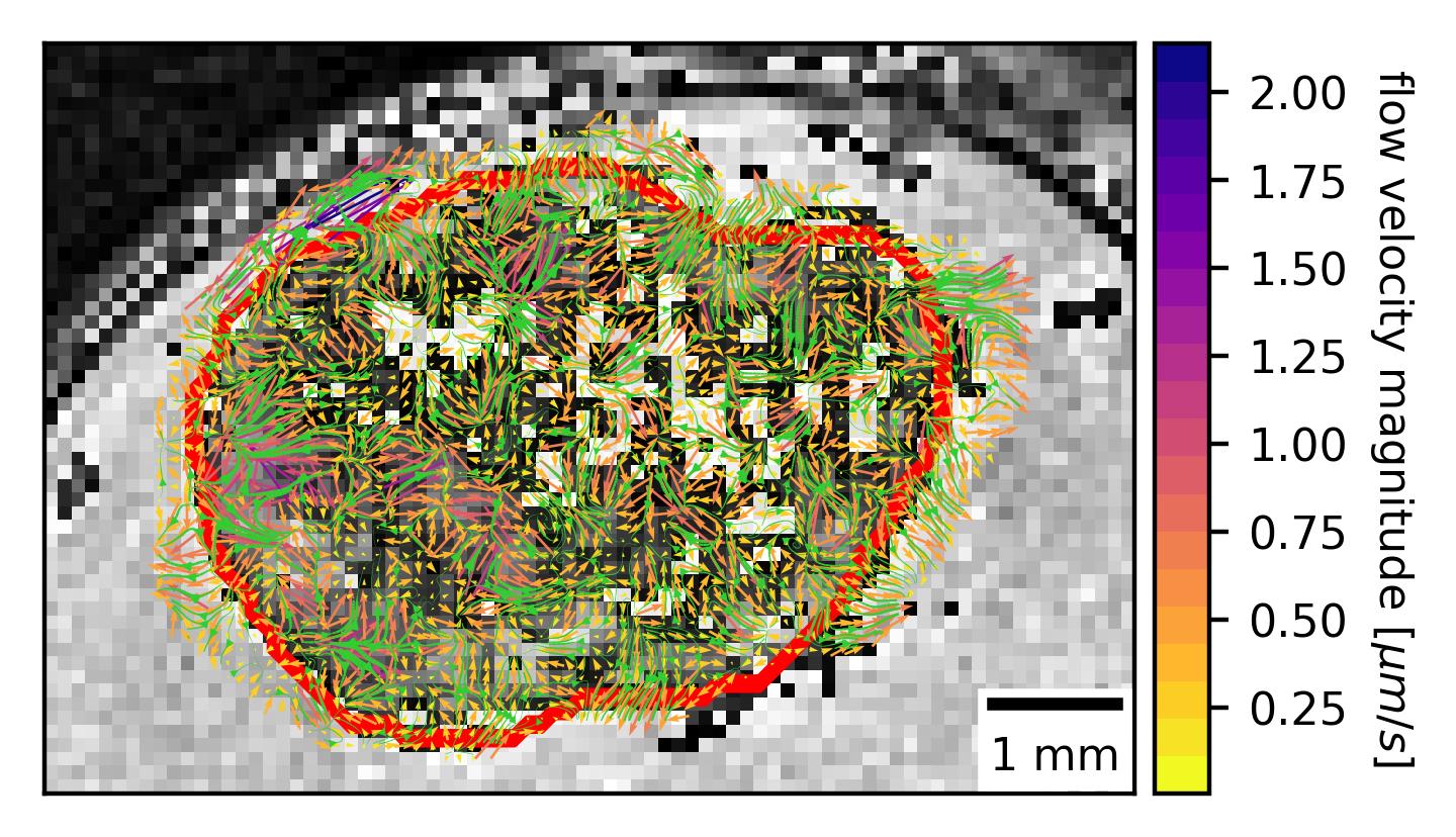 MRI with Contrast Shows Heterogenous Interstitial Fluid Flow in Glioblastoma
