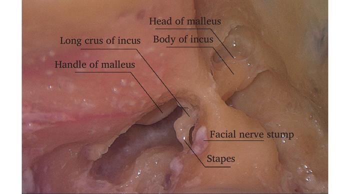 The tympanic cavity was accessed through the mastoid process.