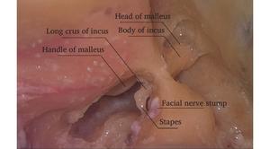 The tympanic cavity was accessed through the mastoid process.