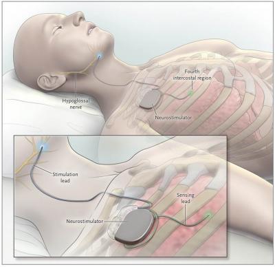 Inspire® Upper Airway Stimulation Therapy