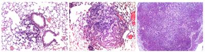 Lung Cancer