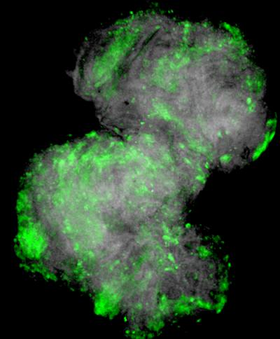 Epithelial Tumor