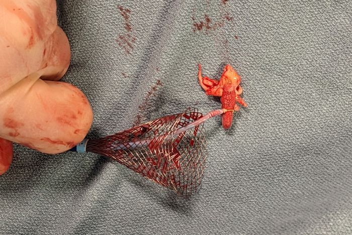 mitral valve clip device removed via catheter