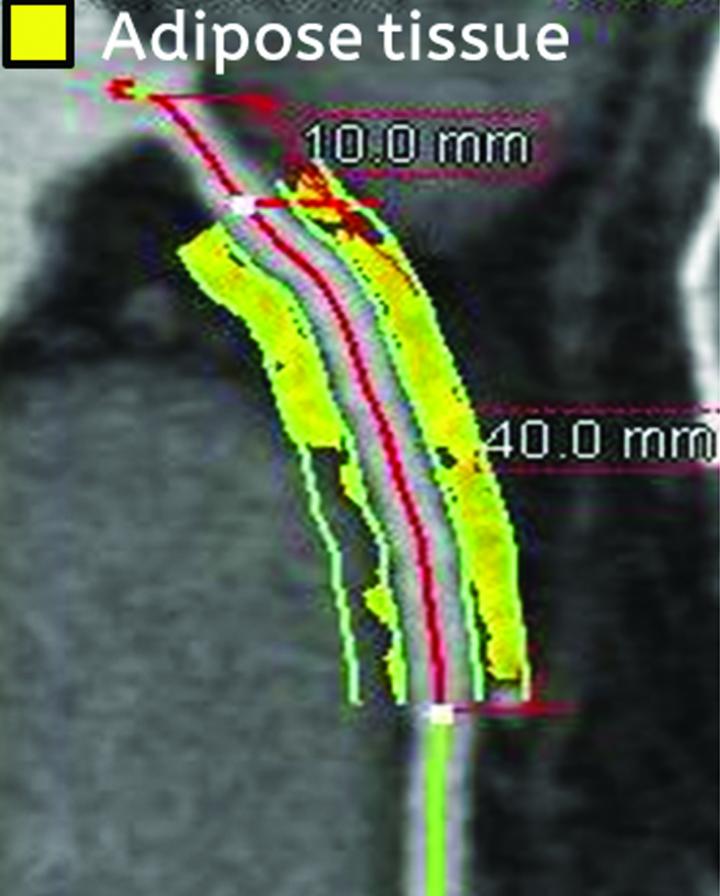 Finally, a Noninvasive Measure to Identify Dangerous Blood Vessel Plaques (3 of 4)