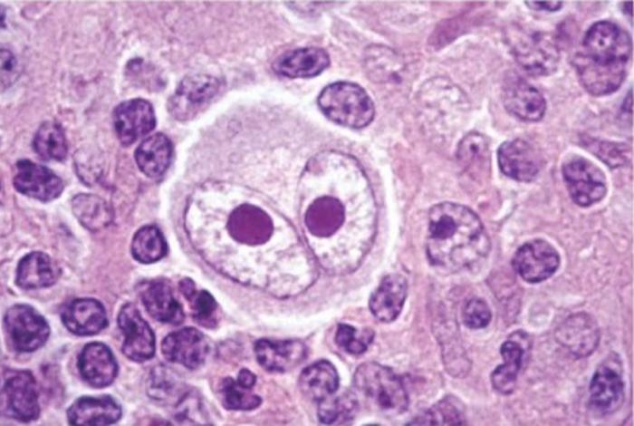 Understanding the Origins of Hodgkin Lymphoma Cells Could Lead to Better Diagnostics