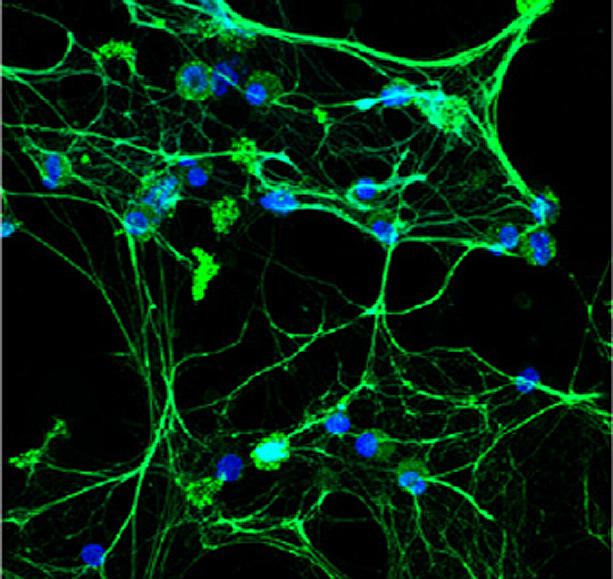 Lupus White Blood Cells Form Destructive Traps