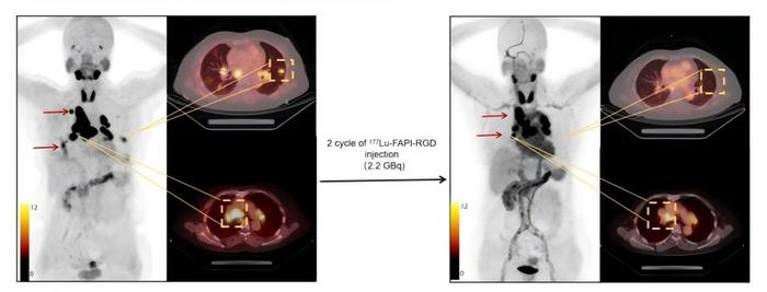 One representative patient with a favorable therapeutic response after 2 cycles of 177Lu-FAPI-RGD.