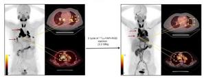 One representative patient with a favorable therapeutic response after 2 cycles of 177Lu-FAPI-RGD.