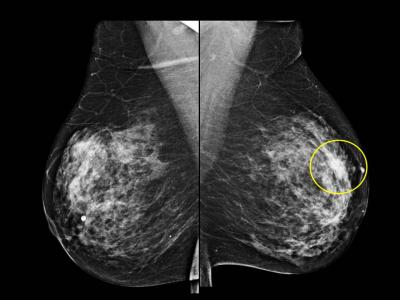 Ultrasound Biopsy