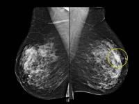 Ultrasound Biopsy
