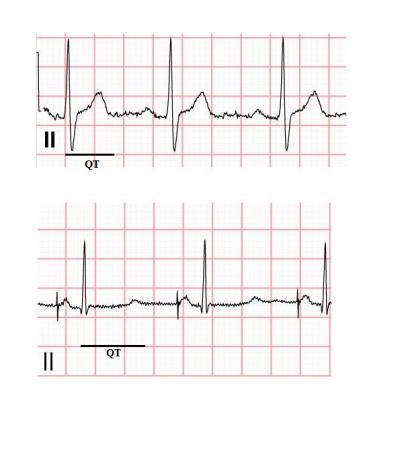 LQTS Patient ECG